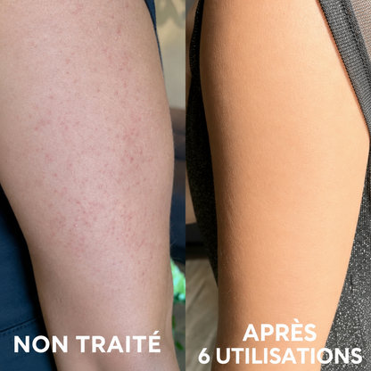 Loryne™ | Crème Anti-Peau de Fraise
