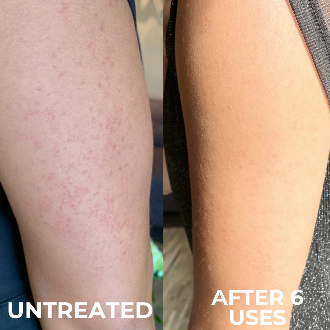 Loryne™ | Crème Anti-Peau de Fraise