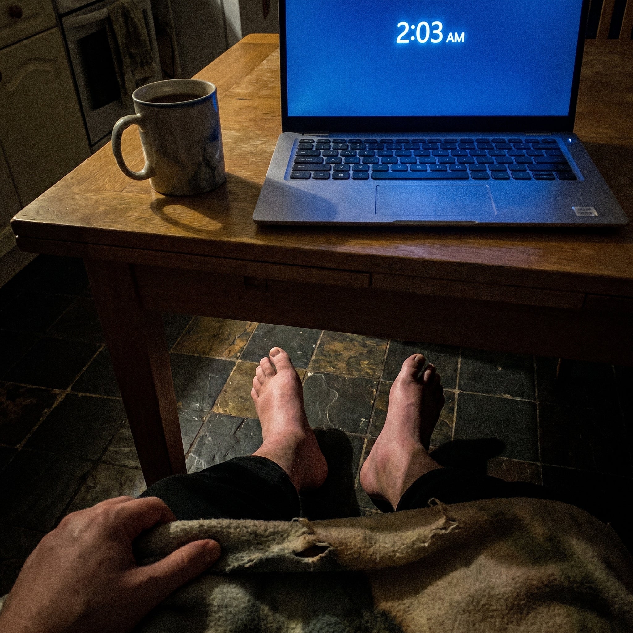 Severe leg edema — swollen ankles and feet