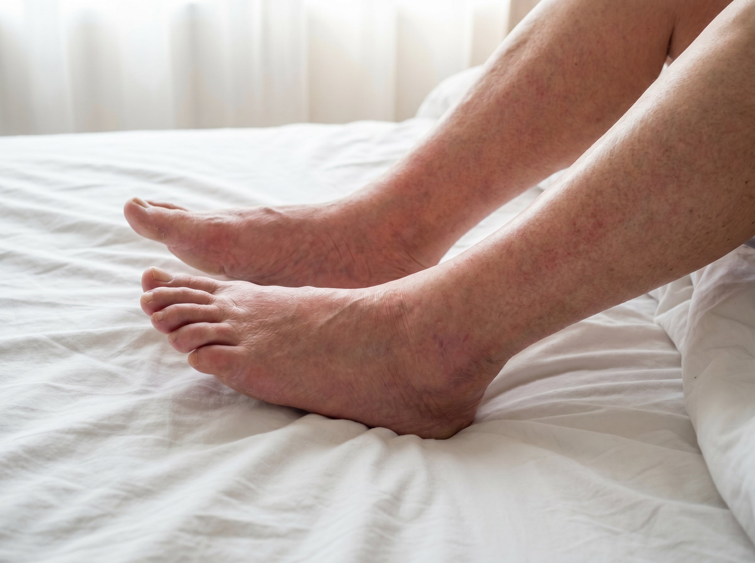 Water pills, compression socks, failed treatments