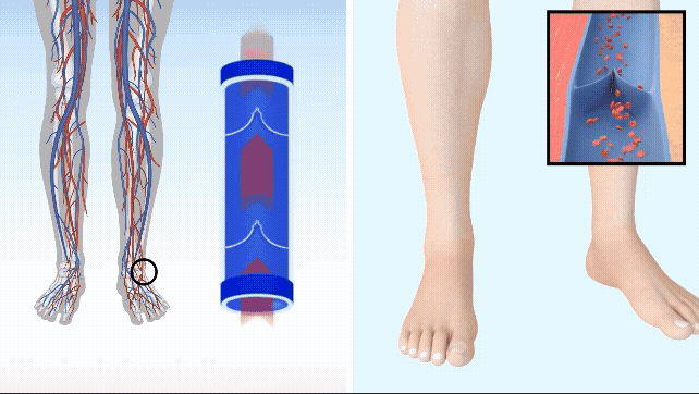 Lymphatic drainage activation