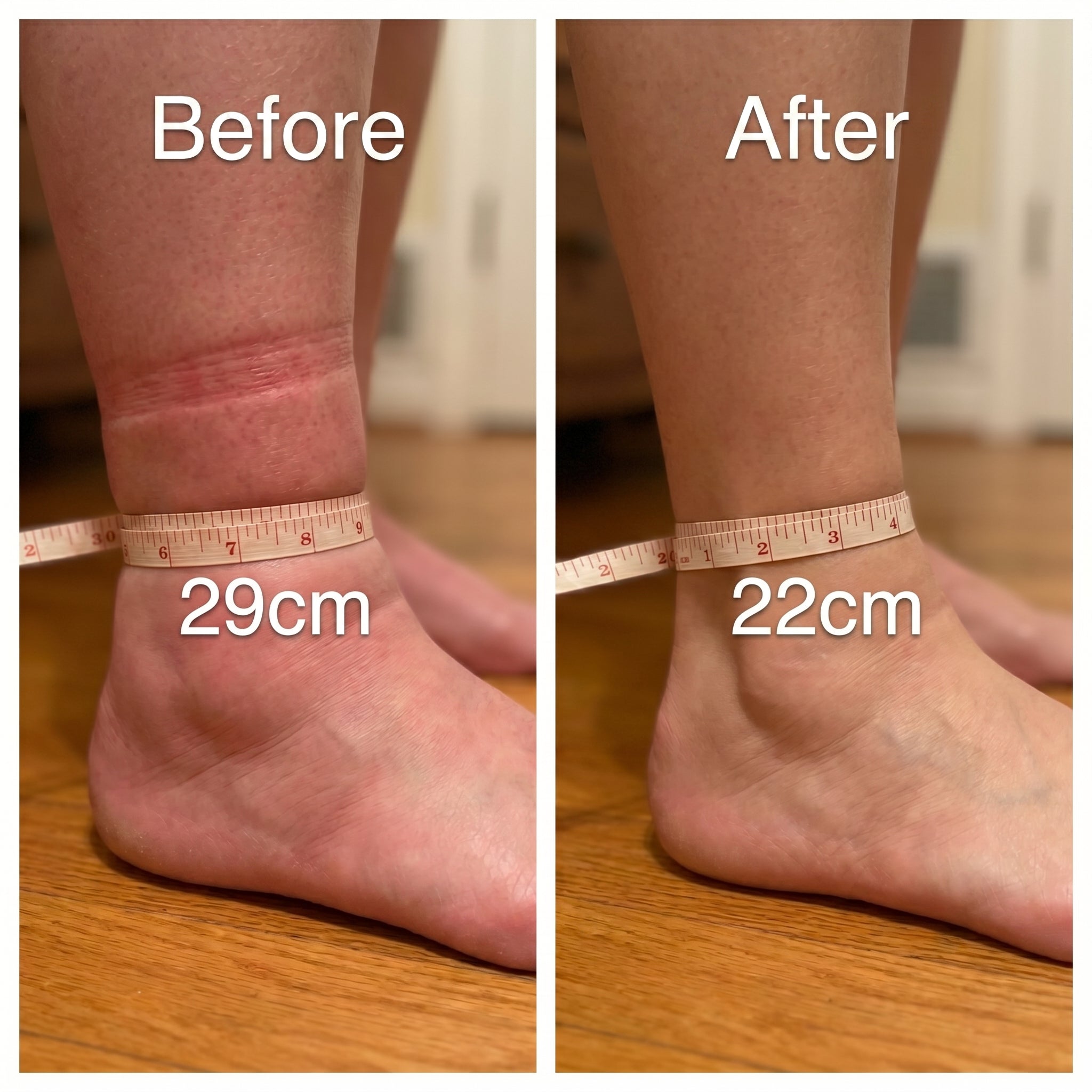 Week by week edema improvement results