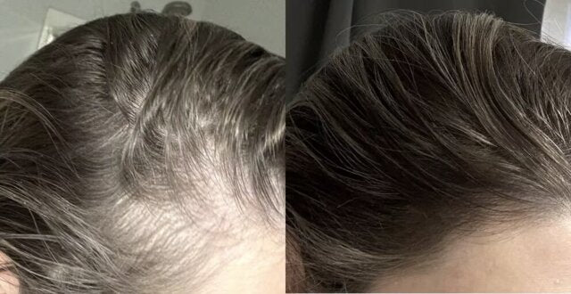 Loryne&trade; Hair Growth Serum