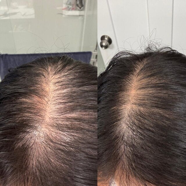 Loryne&trade; Hair Growth Serum
